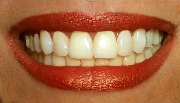 Healthy White Teeth
