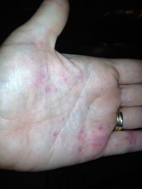 Hands are breaking out with rash/sores - Hedgehog Central – Hedgehog